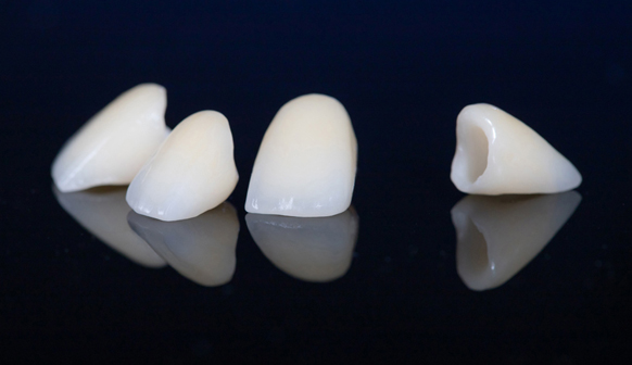 Dental Crown in Mesa, AZ: Affordable and Quality Solutions