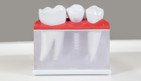 Dental Implants in Mesa, AZ: Restoring Function and Confidence