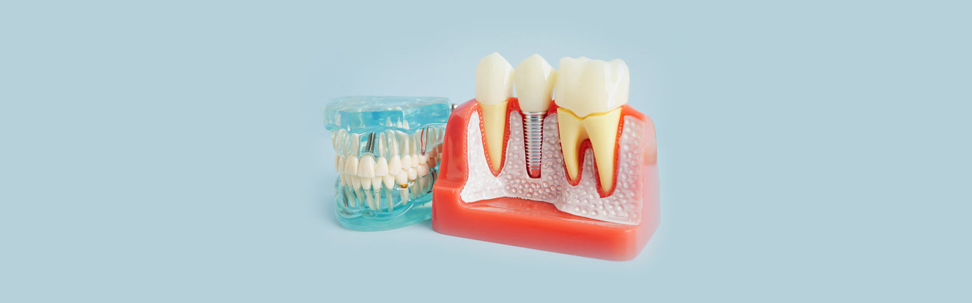 Dental Implants