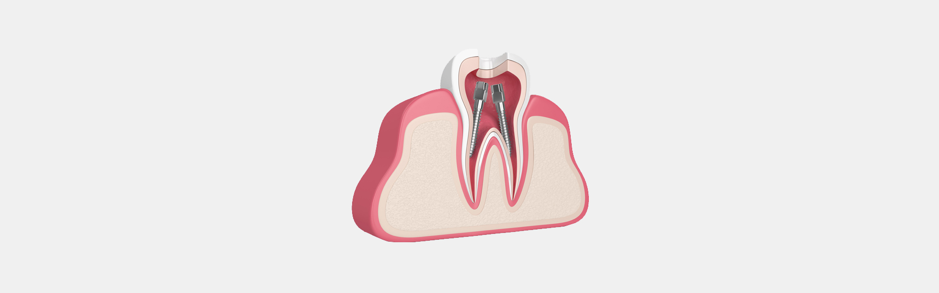 Root Canal Therapy